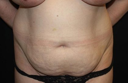 Tummy Tuck Before & After Patient #22437