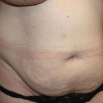 Tummy Tuck Before & After Patient #22437