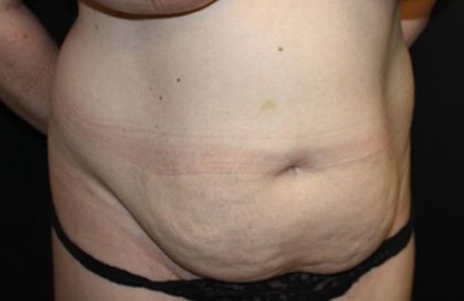 Tummy Tuck Before & After Patient #22437