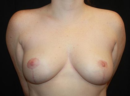 Breast Reduction Before & After Patient #21085