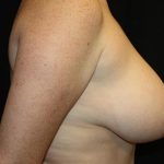 Breast Reduction Before & After Patient #21085