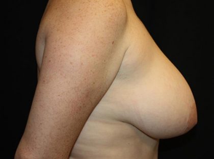 Breast Reduction Before & After Patient #21085