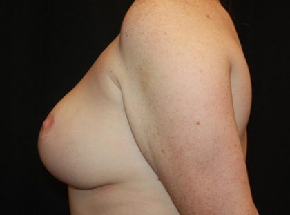 Breast Reduction Before & After Patient #21085