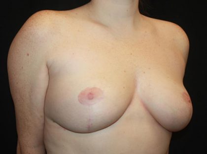 Breast Reduction Before & After Patient #21085