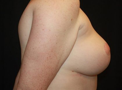 Breast Reduction Before & After Patient #21085