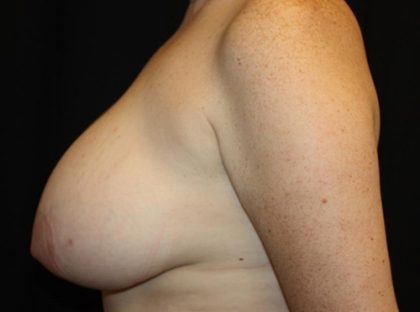 Breast Reduction Before & After Patient #21085