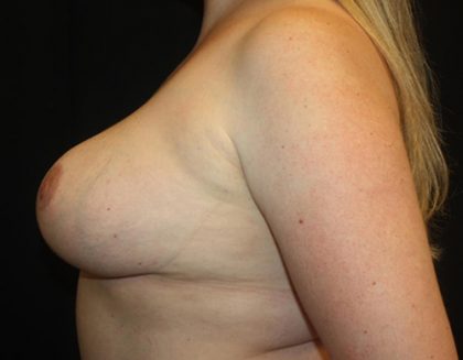 Breast Reduction Before & After Patient #23655