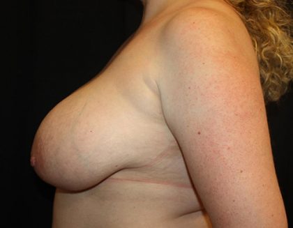 Breast Reduction Before & After Patient #23655