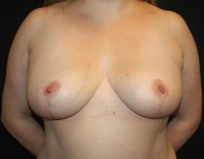 Breast Reduction Before & After Patient #23655