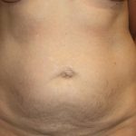 Tummy Tuck Before & After Patient #22685