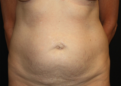 Tummy Tuck Before & After Patient #22685