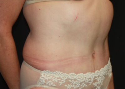 Tummy Tuck Before & After Patient #22685