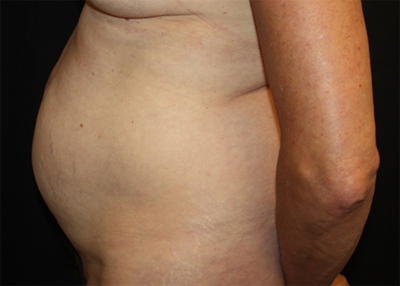Tummy Tuck Before & After Patient #22685