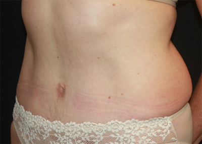 Tummy Tuck Before & After Patient #22685