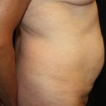 Tummy Tuck Before & After Patient #22685