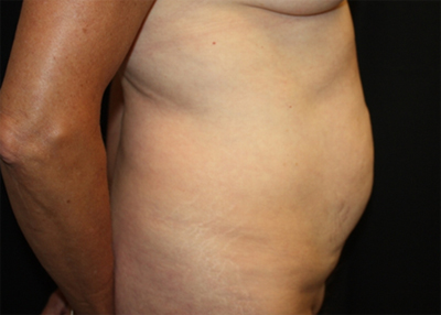 Tummy Tuck Before & After Patient #22685