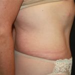 Tummy Tuck Before & After Patient #22685