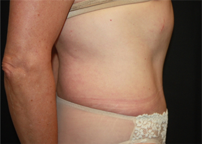Tummy Tuck Before & After Patient #22685