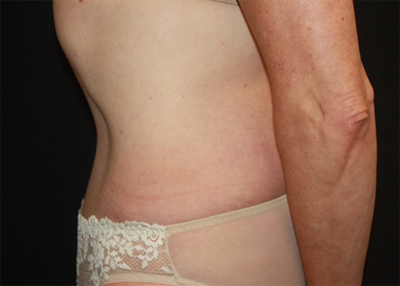 Tummy Tuck Before & After Patient #22685