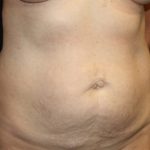 Tummy Tuck Before & After Patient #22685