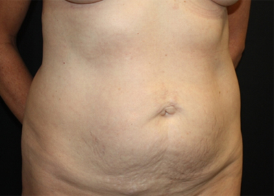 Tummy Tuck Before & After Patient #22685