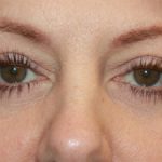 Blepharoplasty Before & After Patient #20231