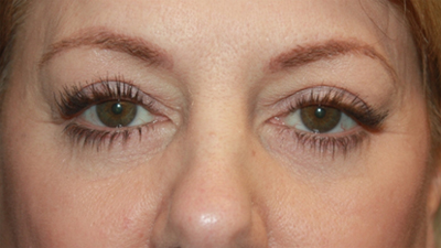 Blepharoplasty Before & After Patient #20231