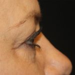 Blepharoplasty Before & After Patient #20231