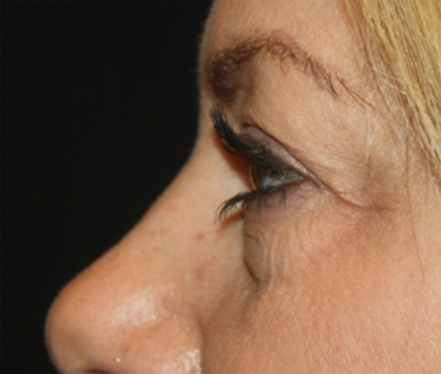 Blepharoplasty Before & After Patient #20231