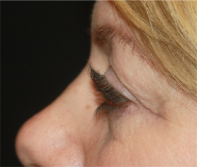 Blepharoplasty Before & After Patient #20231