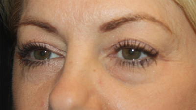 Blepharoplasty Before & After Patient #20231