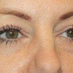 Blepharoplasty Before & After Patient #20231