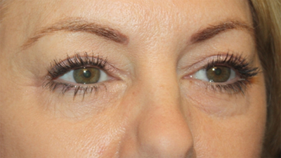 Blepharoplasty Before & After Patient #20231