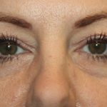 Blepharoplasty Before & After Patient #20231