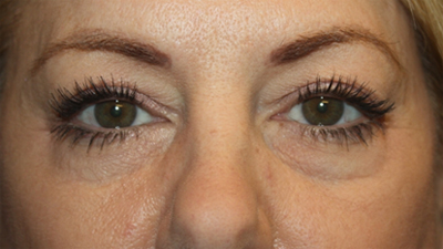 Blepharoplasty Before & After Patient #20231