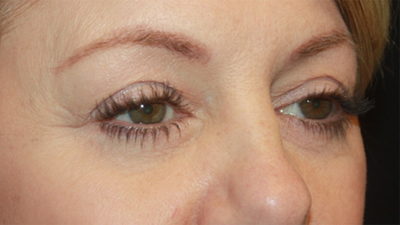Blepharoplasty Before & After Patient #20231