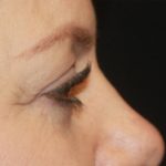 Blepharoplasty Before & After Patient #20231