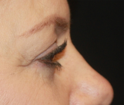 Blepharoplasty Before & After Patient #20231