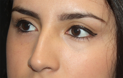 Rhinoplasty Before & After Patient #21769