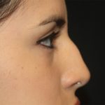 Rhinoplasty Before & After Patient #21769