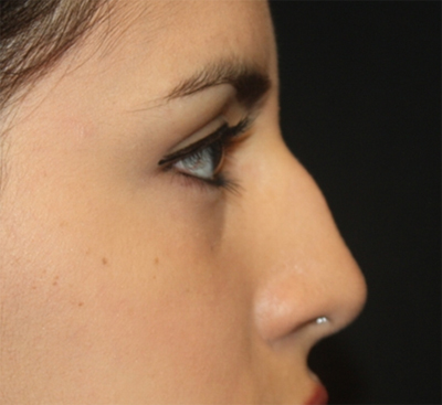 Rhinoplasty Before & After Patient #21769