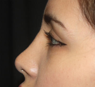 Rhinoplasty Before & After Patient #21769