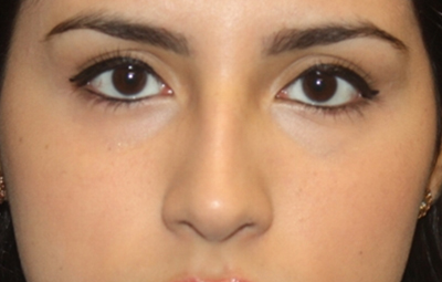 Rhinoplasty Before & After Patient #21769