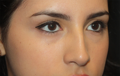 Rhinoplasty Before & After Patient #21769