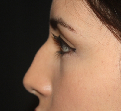 Rhinoplasty Before & After Patient #21769