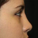 Rhinoplasty Before & After Patient #21769