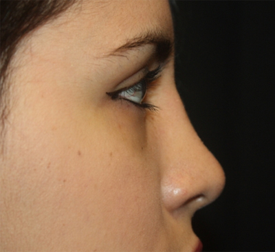 Rhinoplasty Before & After Patient #21769