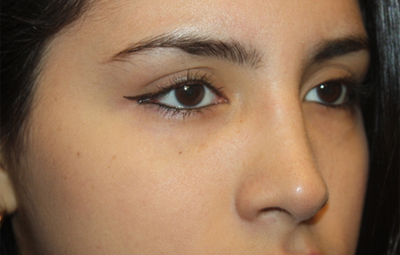 Rhinoplasty Before & After Patient #21769