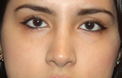 Rhinoplasty Before & After Patient #21769