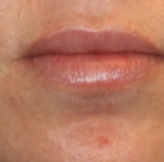 Injectable Fillers Before & After Patient #23274